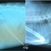 pleural effusion before-after thoracocentesis